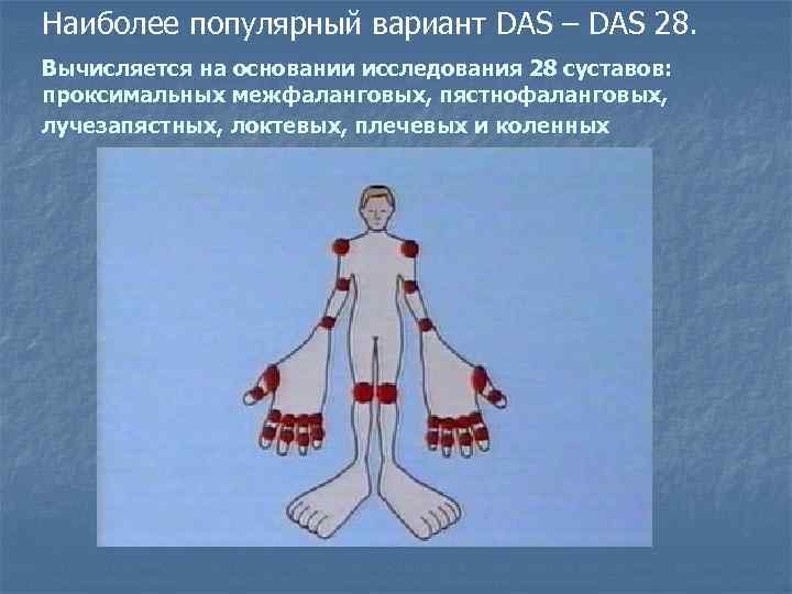 Наиболее популярный вариант DAS – DAS 28. Вычисляется на основании исследования 28 суставов: проксимальных