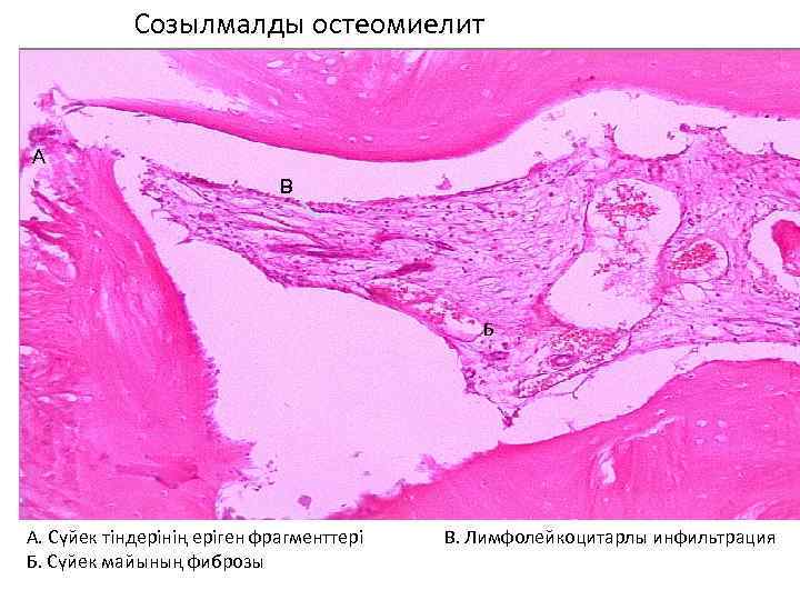 Созылмалды остеомиелит А В Б А. Сүйек тіндерінің еріген фрагменттері Б. Сүйек майының фиброзы