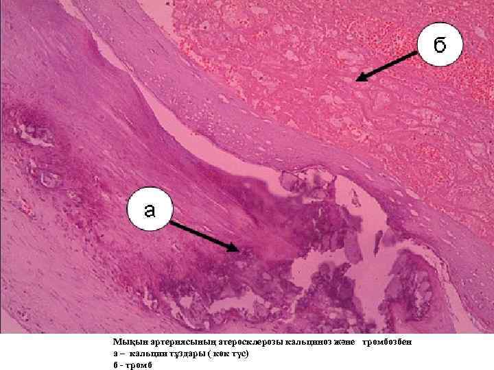 Мықын артериясының атеросклерозы кальциноз және тромбозбен а – кальции тұздары ( көк түс) б