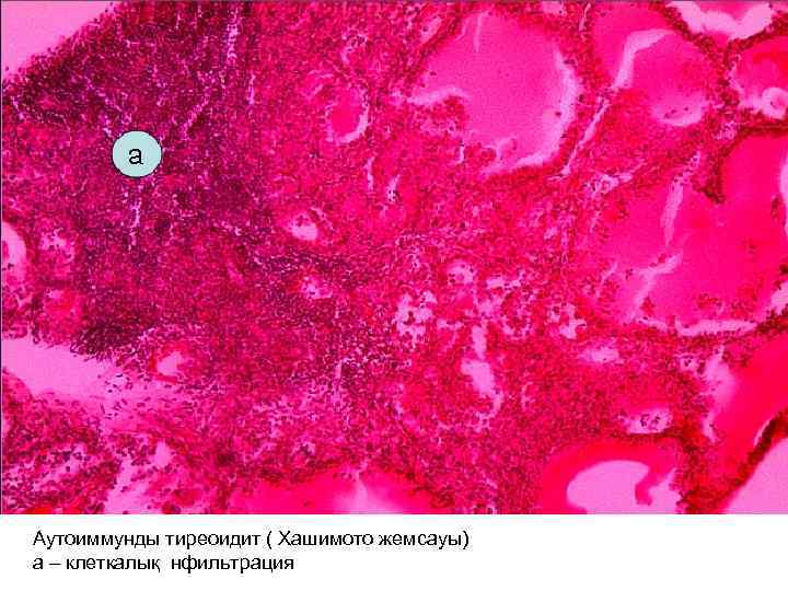 Аутоиммунды тиреоидит ( Хашимото жемсауы) а – клеткалық нфильтрация 