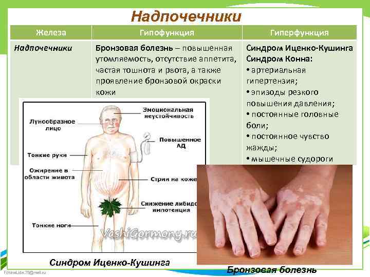 Надпочечники Железа Надпочечники Гипофункция Гиперфункция Бронзовая болезнь – повышенная утомляемость, отсутствие аппетита, частая тошнота