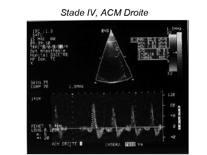 Stade IV, ACM Droite 