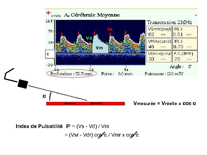 Vs Vd Vm α Vmesurée = Vréelle x cos α Index de Pulsatilité IP