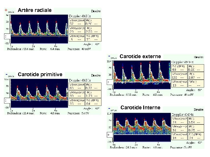 Artère radiale Carotide externe Carotide primitive Carotide Interne 
