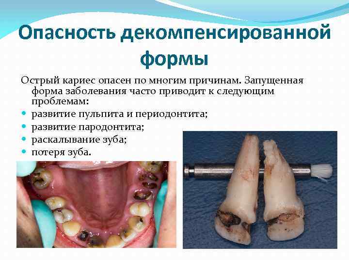 Опасность декомпенсированной формы Острый кариес опасен по многим причинам. Запущенная форма заболевания часто приводит