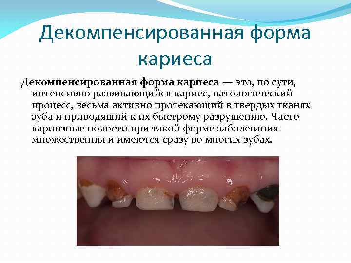 Декомпенсированная форма кариеса — это, по сути, интенсивно развивающийся кариес, патологический процесс, весьма активно