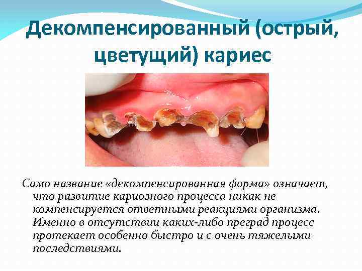 Декомпенсированный (острый, цветущий) кариес Само название «декомпенсированная форма» означает, что развитие кариозного процесса никак