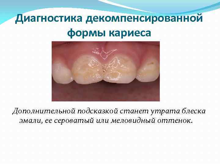 Диагностика декомпенсированной формы кариеса Дополнительной подсказкой станет утрата блеска эмали, ее сероватый или меловидный