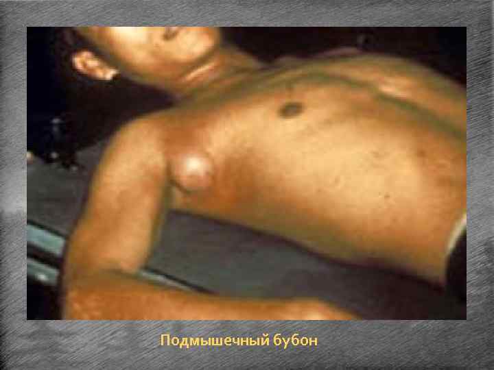 Подмышечный бубон 