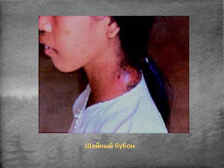 Шейный бубон 