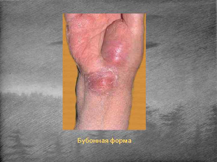 Бубонная форма 