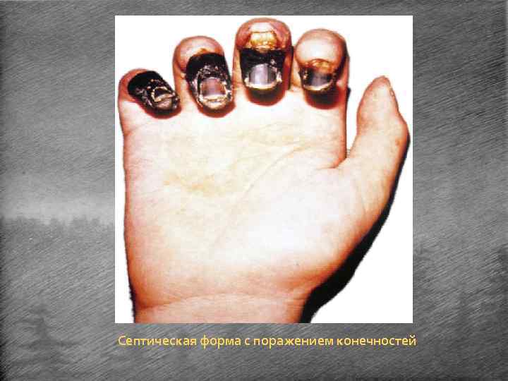 Септическая форма с поражением конечностей 