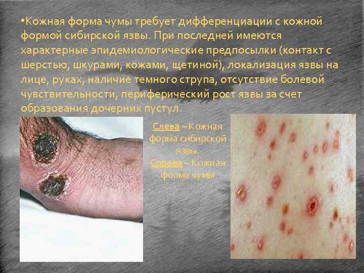  • Кожная форма чумы требует дифференциации с кожной формой сибирской язвы. При последней