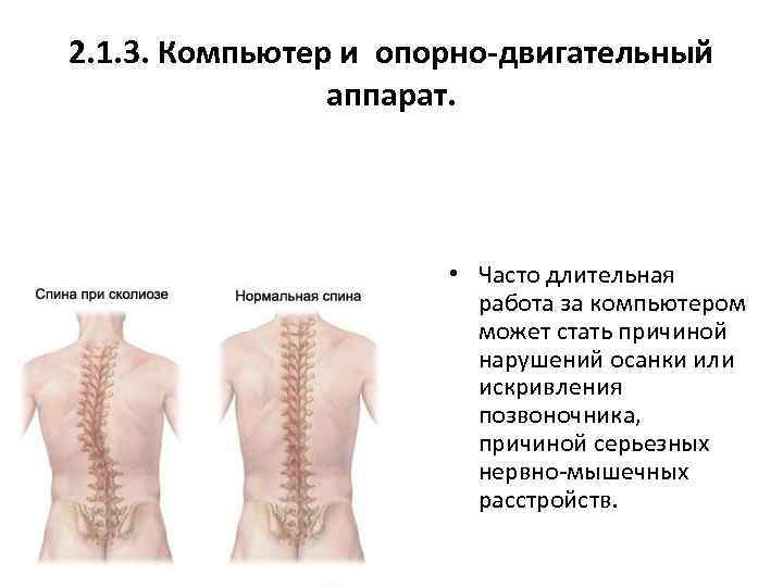 2. 1. 3. Компьютер и опорно-двигательный аппарат. • Часто длительная работа за компьютером может