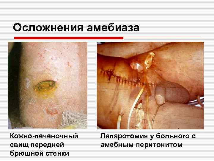 Осложнения амебиаза Кожно-печеночный свищ передней брюшной стенки Лапаротомия у больного с амебным перитонитом 