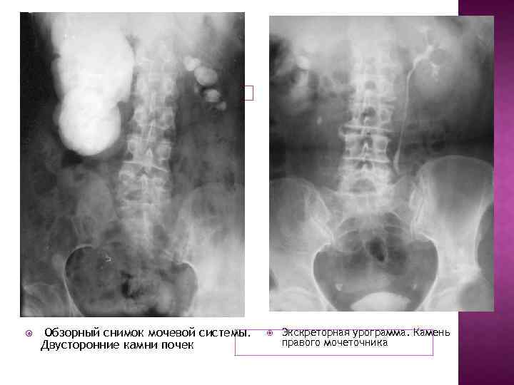  Обзорный снимок мочевой системы. Двусторонние камни почек Экскреторная урограмма. Камень правого мочеточника 