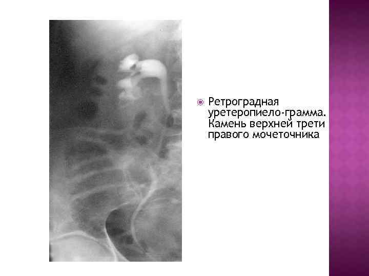  Ретроградная уретеропиело-грамма. Камень верхней трети правого мочеточника 