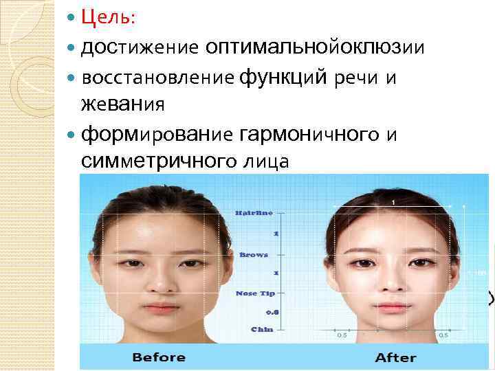 Цель: достижение оптимальнойоклюзии восстановление функций речи и жевания формирование гармоничного и симметричного лица 