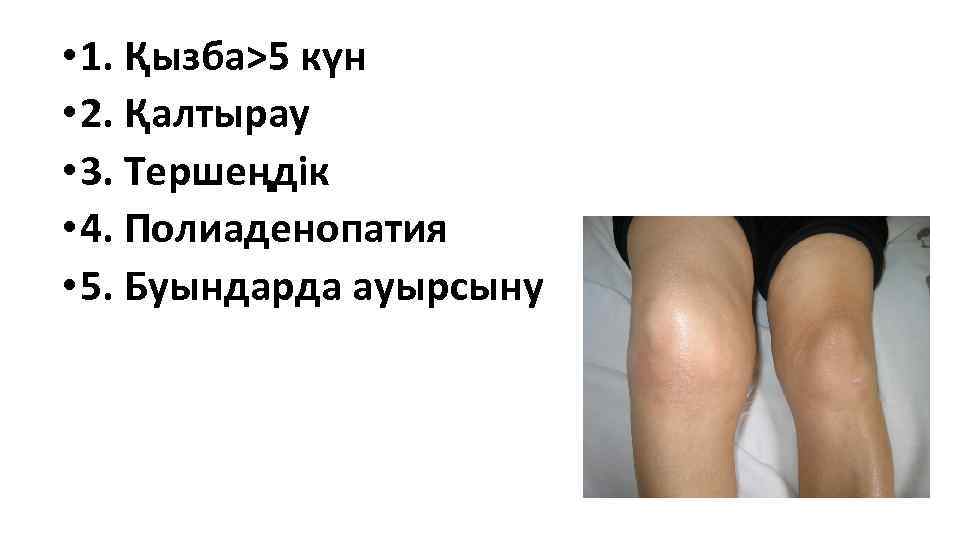  • 1. Қызба>5 күн • 2. Қалтырау • 3. Тершеңдік • 4. Полиаденопатия