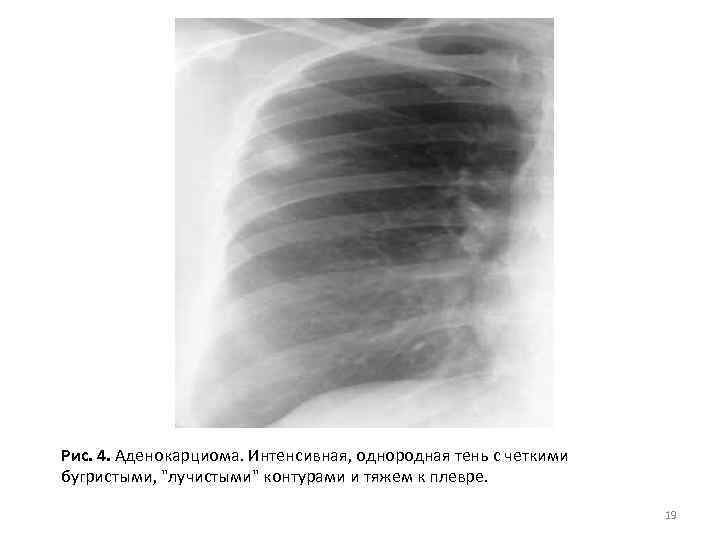 Рис. 4. Аденокарциома. Интенсивная, однородная тень с четкими бугристыми, "лучистыми" контурами и тяжем к