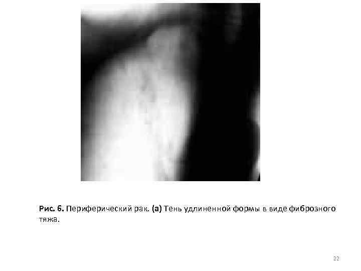 Рис. 6. Периферический рак. (а) Тень удлиненной формы в виде фиброзного тяжа. 22 