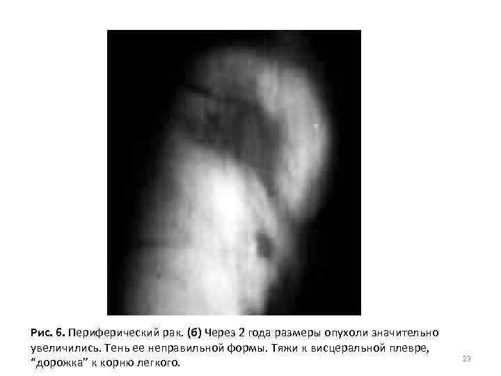 Рис. 6. Периферический рак. (б) Через 2 года размеры опухоли значительно увеличились. Тень ее
