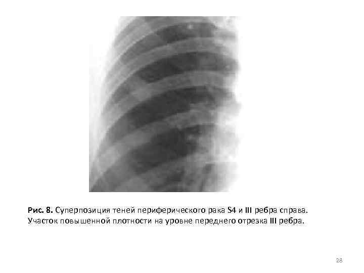 Рис. 8. Суперпозиция теней периферического рака S 4 и III ребра справа. Участок повышенной