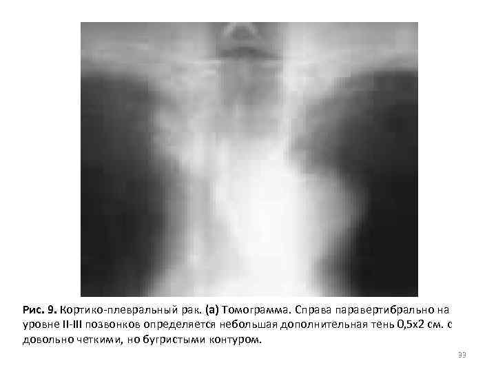 Рис. 9. Кортико-плевральный рак. (а) Томограмма. Справа паравертибрально на уровне II-III позвонков определяется небольшая