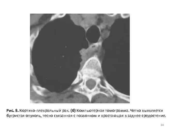 Рис. 9. Кортико-плевральный рак. (б) Компьютерная томограмма. Четко выявляется бугристая опухоль, тесно связанная с