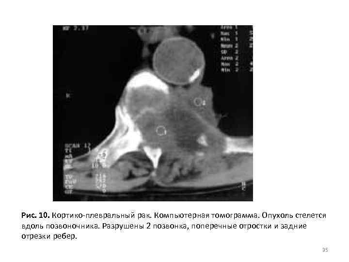 Рис. 10. Кортико-плевральный рак. Компьютерная томограмма. Опухоль стелется вдоль позвоночника. Разрушены 2 позвонка, поперечные