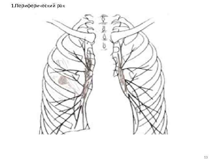  1. Периферический рак 53 
