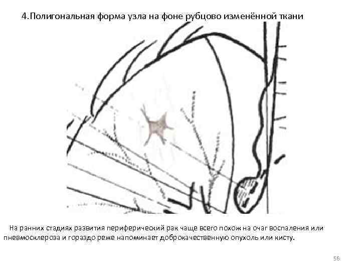  4. Полигональная форма узла на фоне рубцово изменённой ткани На ранних стадиях развития