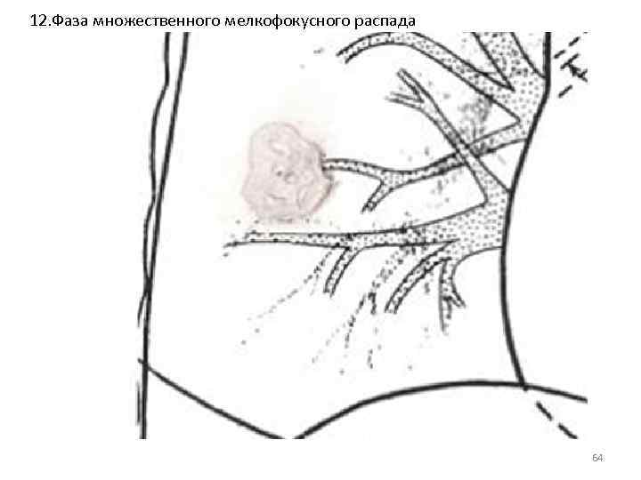 12. Фаза множественного мелкофокусного распада 64 