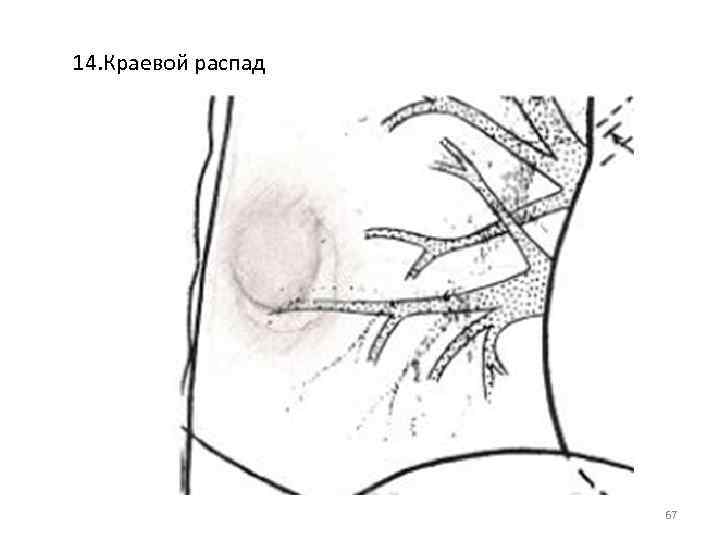 14. Краевой распад 67 