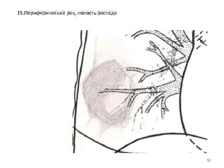 15. Периферический рак, полость распада 68 