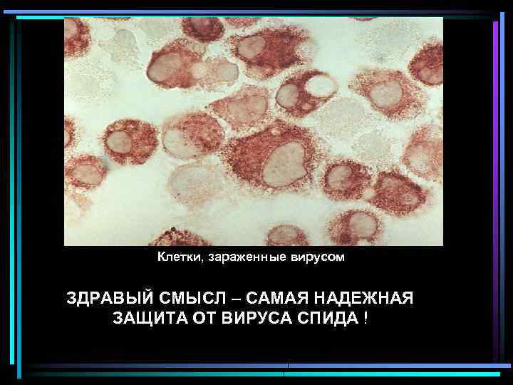 Клетки, зараженные вирусом ЗДРАВЫЙ СМЫСЛ – САМАЯ НАДЕЖНАЯ ЗАЩИТА ОТ ВИРУСА СПИДА ! 
