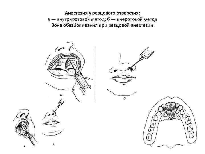 Резцовый. Резцовая анестезия внеротовой метод. Резцовая проводниковая анестезия. Проводниковая анестезия в стоматологии резцовая. Внутриносовая резцовая анестезия.