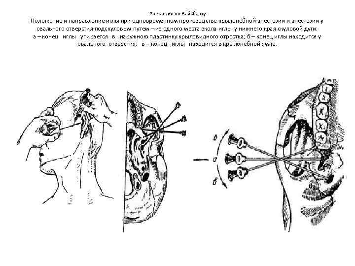 Анестезия по берше