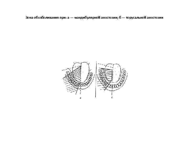 Зона обезболивания при: а — мандибулярной анестезии; б — торусальной анестезии 