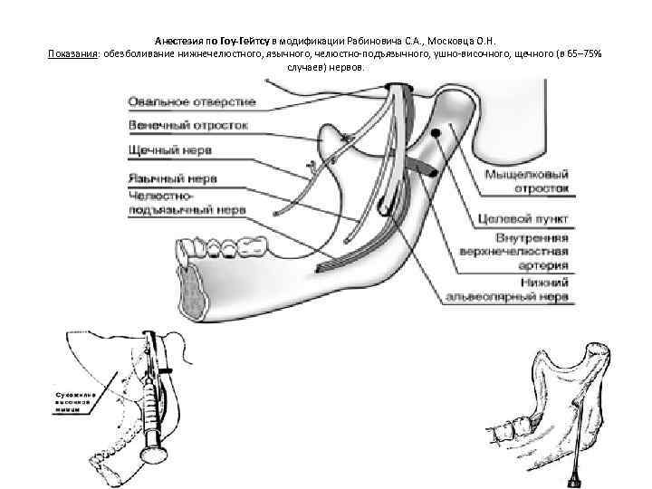 Проводниковая анестезия на нижней челюсти схема
