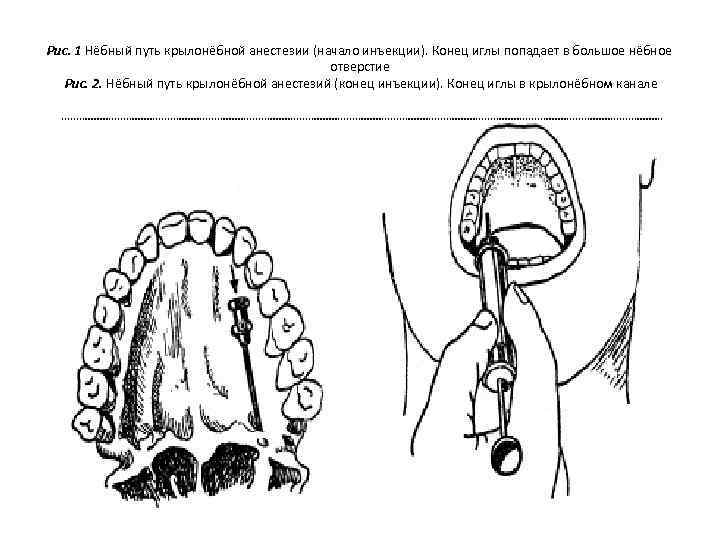 Проводниковая анестезия на нижней челюсти схема