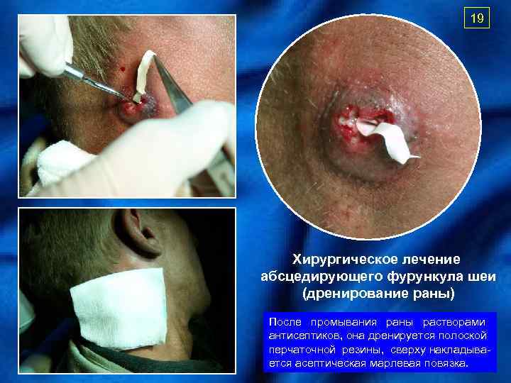 19 Хирургическое лечение абсцедирующего фурункула шеи (дренирование раны) После промывания раны растворами антисептиков, она