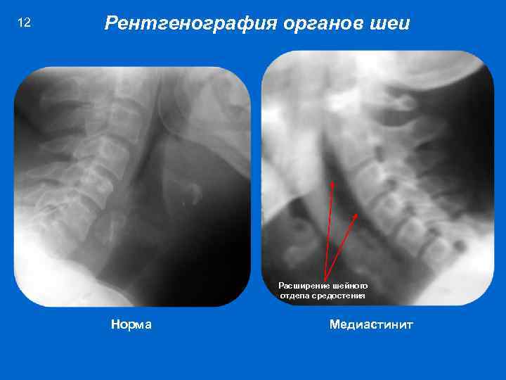 12 Рентгенография органов шеи Расширение шейного отдела средостения Норма Медиастинит 