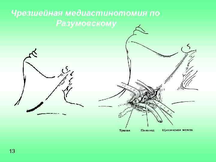 Чрезшейная медиастинотомия по Разумовскому 13 