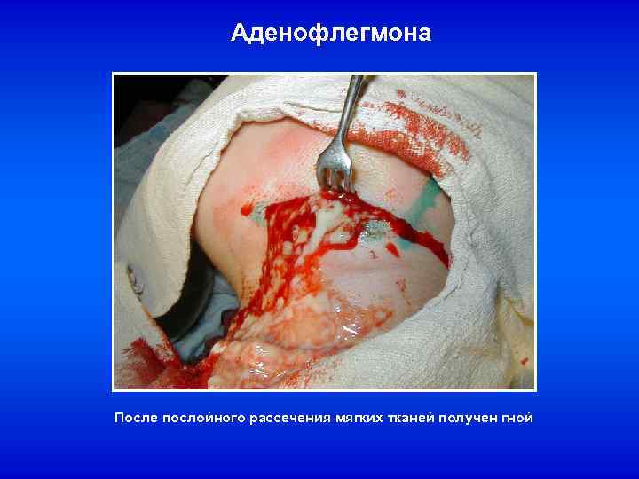Аденофлегмона После послойного рассечения мягких тканей получен гной 