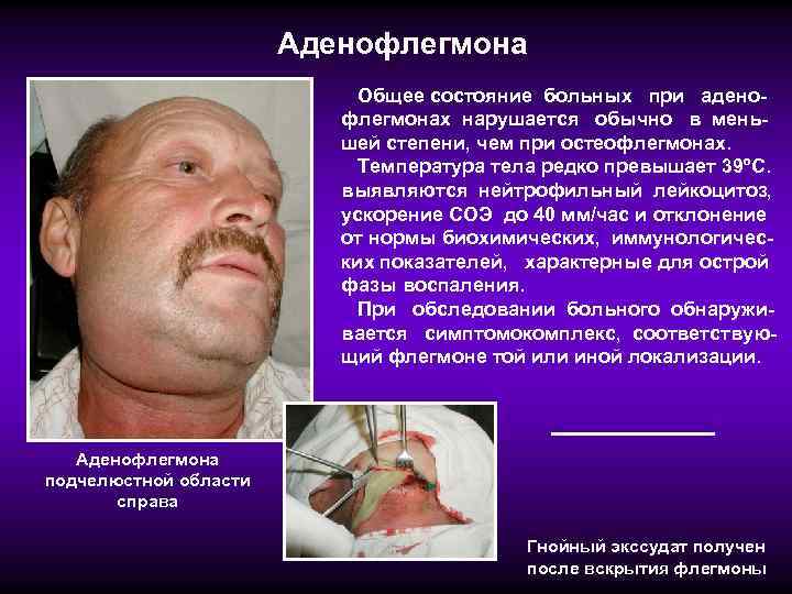 Аденофлегмона Общее состояние больных при аденофлегмонах нарушается обычно в меньшей степени, чем при остеофлегмонах.