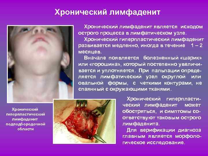 Хронический лимфаденит является исходом острого процесса в лимфатическом узле. Хронический гиперпластический лимфаденит развивается медленно,