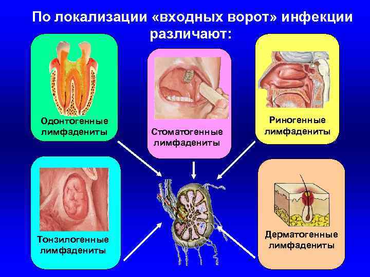 Воспаление наружного геморроидального узла фото