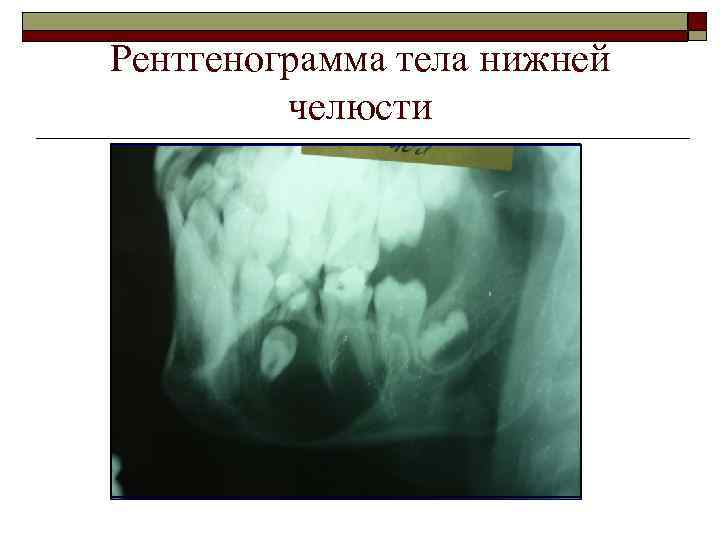 Рентгенограмма тела нижней челюсти 