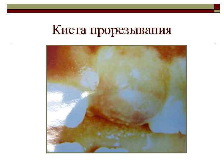 Киста прорезывания 